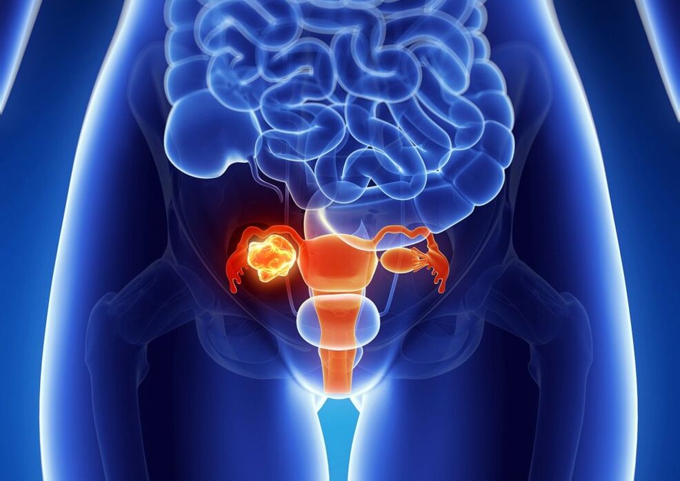 Ovarian pathology in women under the influence of alcohol